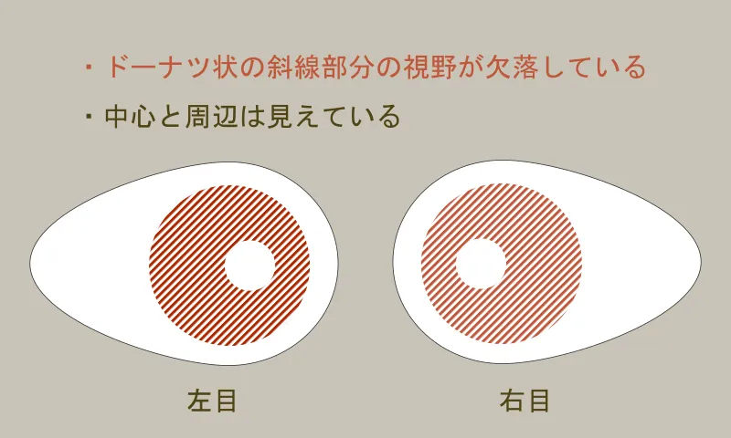 現在の視野状況図